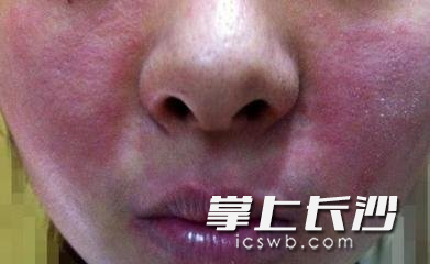 就诊时,文小姐脸部皮肤又红又烫。 就诊时,文小姐脸部皮肤又红又烫。