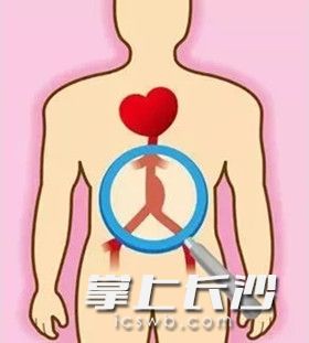 巨大腹主动脉瘤示意图