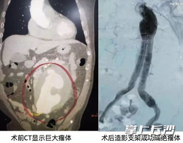 术前术后对比图