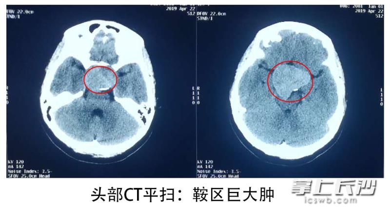 头部CT可见鞍区有一个稍高密度占位，形状不规则。