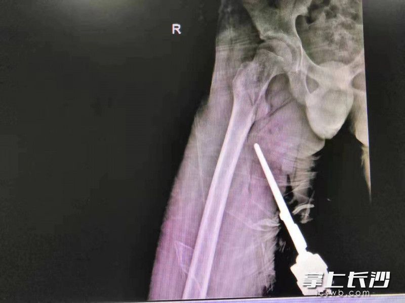 刘小臻(化名)翻越护栏时,不慎被防盗刺刺入大腿内侧。 医院供图 刘小臻(化名)翻越护栏时,不慎被防盗刺刺入大腿内侧。 医院供图