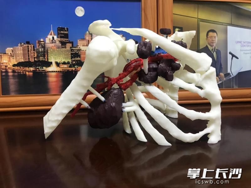 省中医院乳腺外科专家利用模型与患者家属交流并分析病情。长沙晚报全媒体记者 杨蔚然 通讯员 何穰 摄影报道 省中医院乳腺外科专家利用模型与患者家属交流并分析病情。长沙晚报全媒体记者 杨蔚然 通讯员 何穰 摄影报道