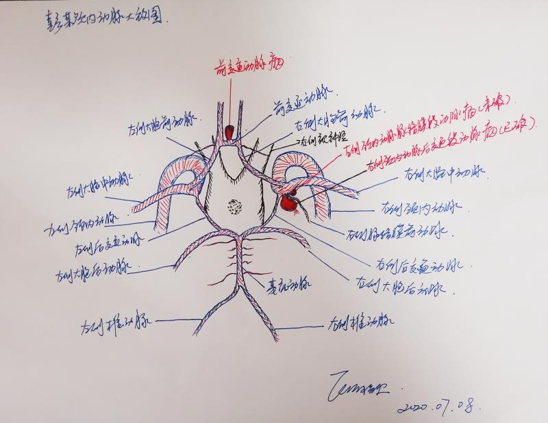 患者颅内动脉示意图。张晓泉 绘