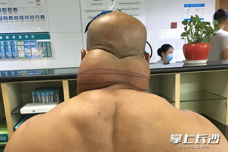 手术前的张先生。