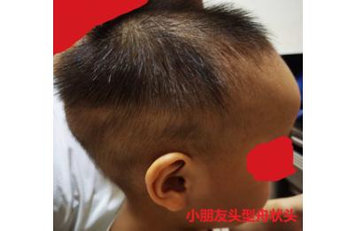 手术前，豆豆头型如橄榄球。