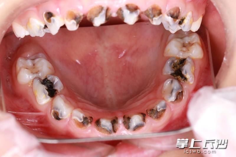 3岁孩子20颗乳牙全被蛀坏。