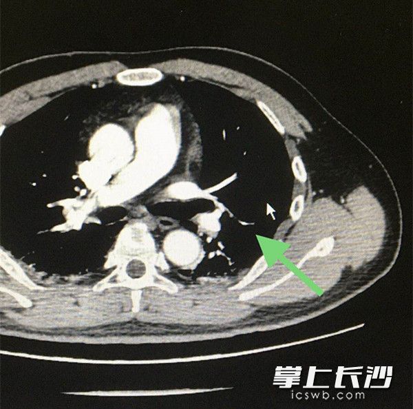 从患者的肺血管造影检查可示，左肺下叶肺动脉分支可见线性充盈缺损，提示肺栓塞。