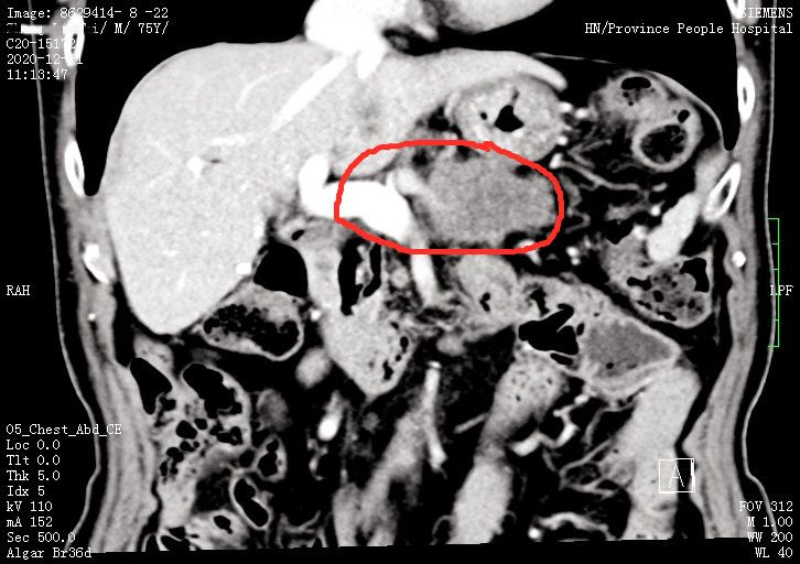 CT上可以看到患者肿瘤及其侵犯的血管和脏器(红圈内)。 CT上可以看到患者肿瘤及其侵犯的血管和脏器(红圈内)。