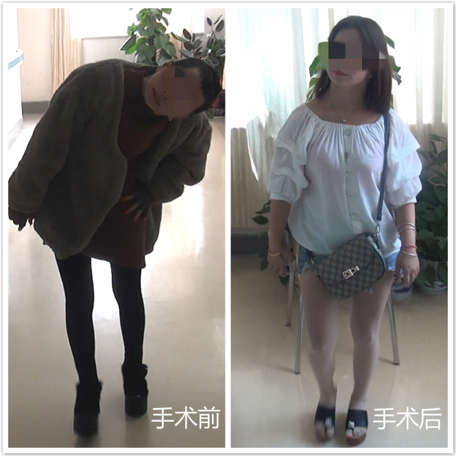 小颜术前和术后对比。  医院供图