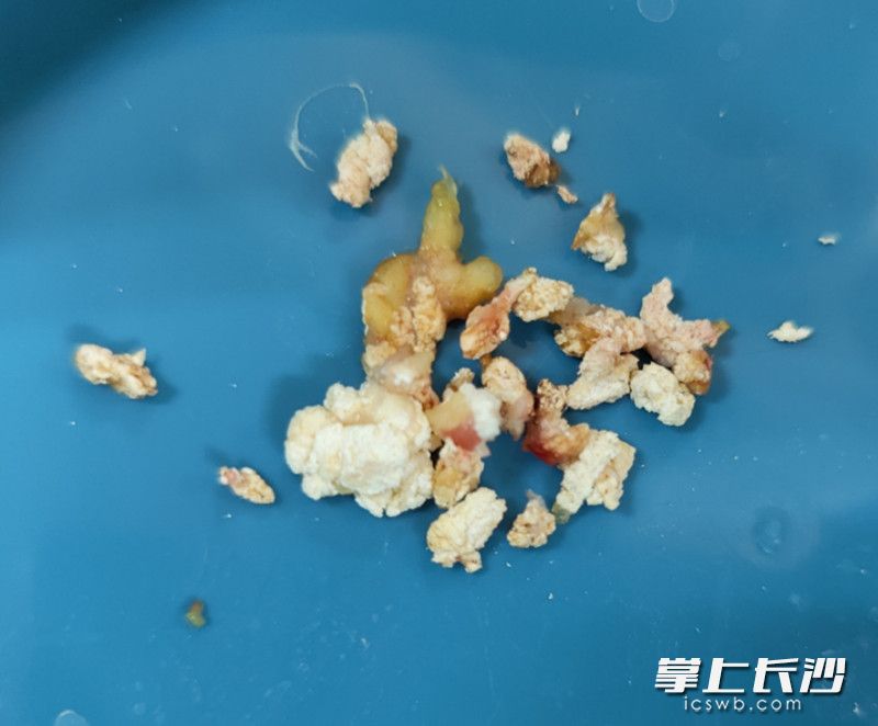 手术中，在患者膝关节腔内取出大量痛风石。医院供图