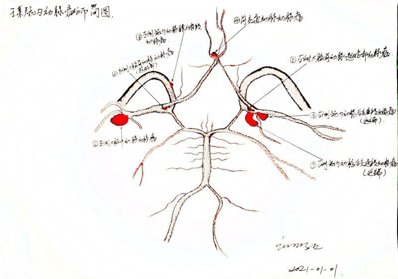 患者颅内7个动脉瘤大致分布。长沙晚报通讯员 张晓泉 绘 患者颅内7个动脉瘤大致分布。长沙晚报通讯员 张晓泉 绘