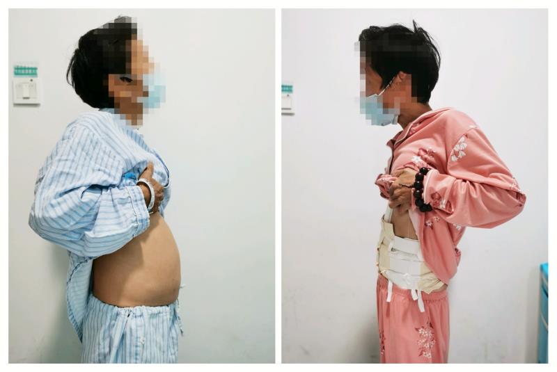 手术后，患者的肚子小了一圈。