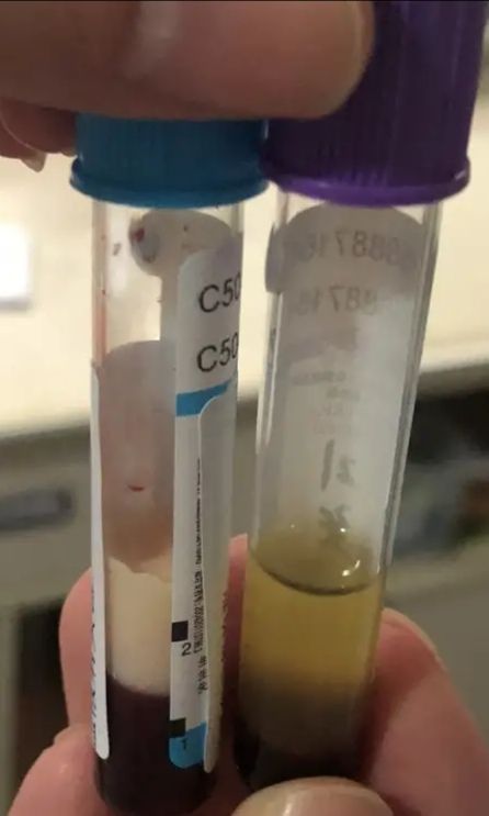 经抽血检查，胰腺炎患者的血液呈白色。长沙晚报通讯员 陈如群 供图