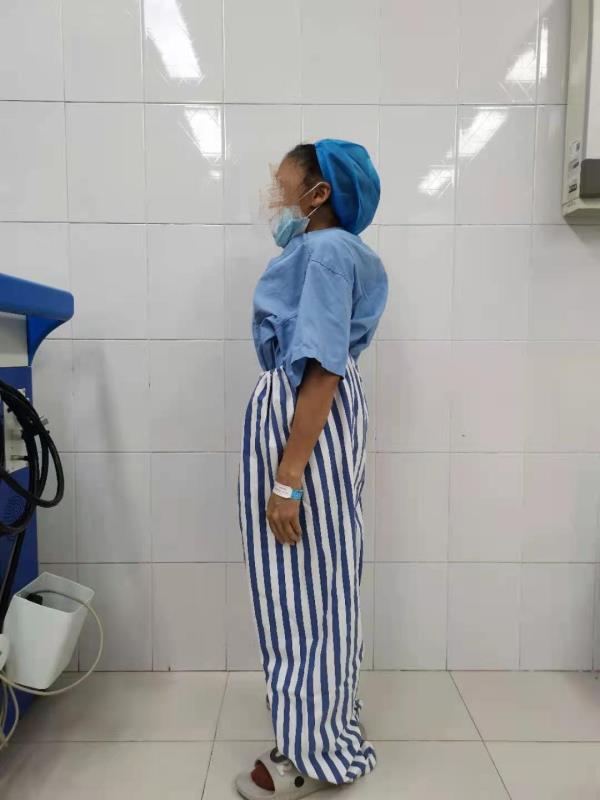 患者有严重的脊柱侧弯、胸廓畸形,手术难度大。 患者有严重的脊柱侧弯、胸廓畸形,手术难度大。