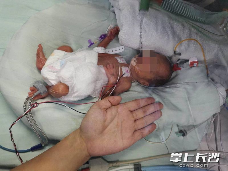 刚出生的睿睿，比成人的巴掌大不了多少。  均为医院供图