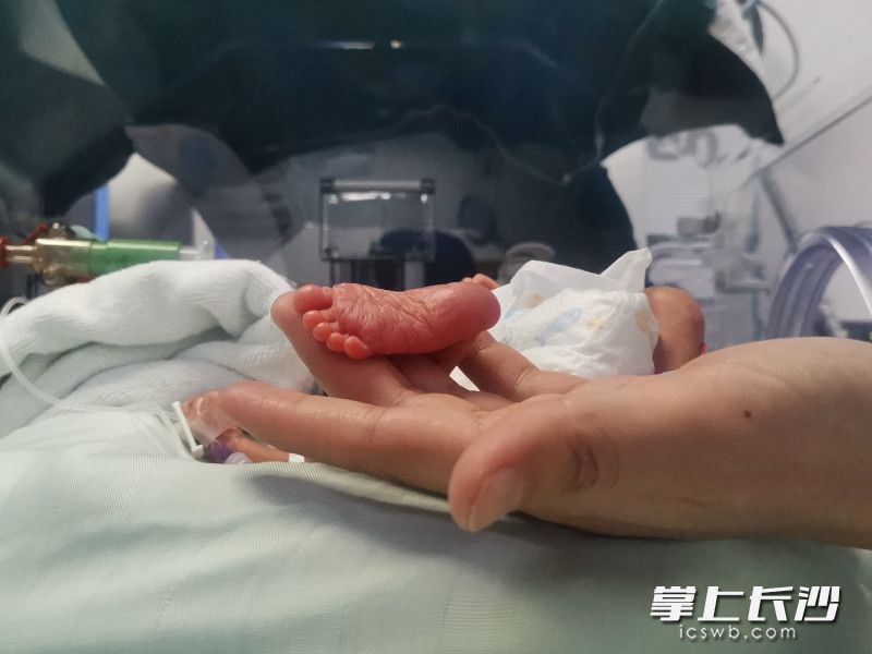 早产的睿睿刚出生时小得可怜。