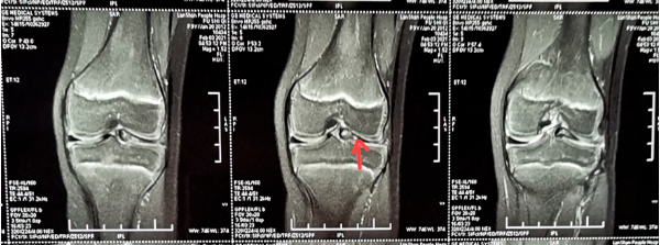 长沙市第四医院骨二科副主任医师熊湘彦仔细查阅了儿左膝MRI（磁共振成像）并进行体格检查，初步诊断其可能是左膝关节盘状半月板受伤后出现破裂，卡压在其关节内，导致膝关节疼痛。均为医院供图