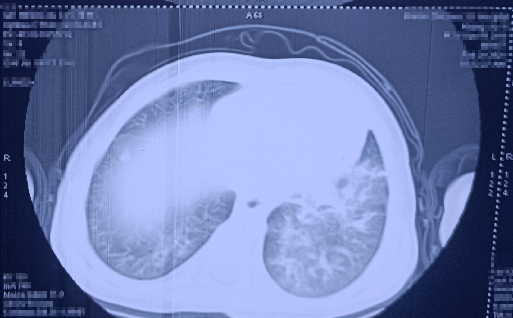 CT结果显示，孩子肺部感染严重。