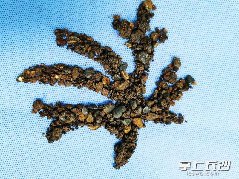 术中取出的大量结石。