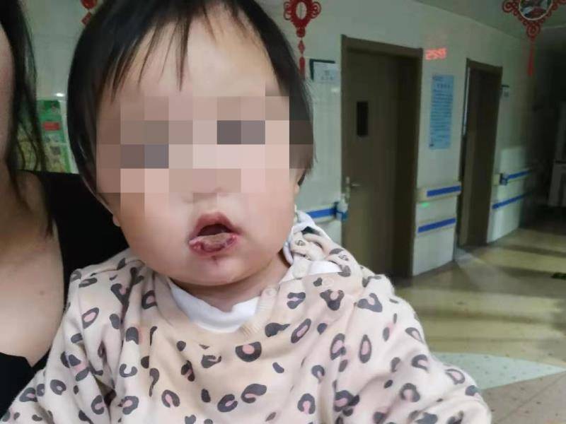 小欣入院时下唇、舌面及口腔黏膜明显糜烂。