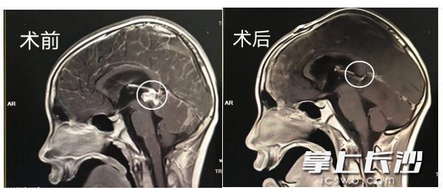 手术成功切除了患儿脑深部肿瘤。  湘雅医院供图