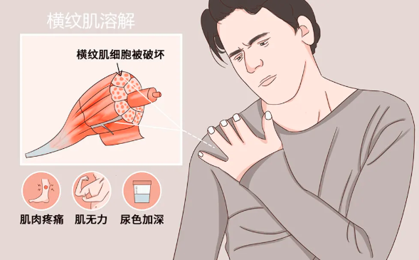 长沙市第四医院急诊科每年都会接诊上百例不同年龄阶段的横纹肌溶解患者，多数是由运动引起的。医院供图