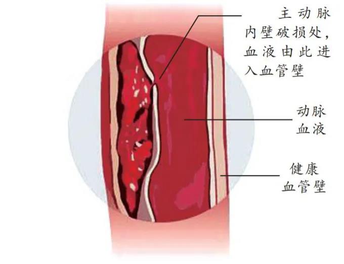 主动脉夹层即因某些原因动脉内膜破裂，血液涌入内膜与中膜之间的腔隙内，形成假腔，像“三明治”一样。