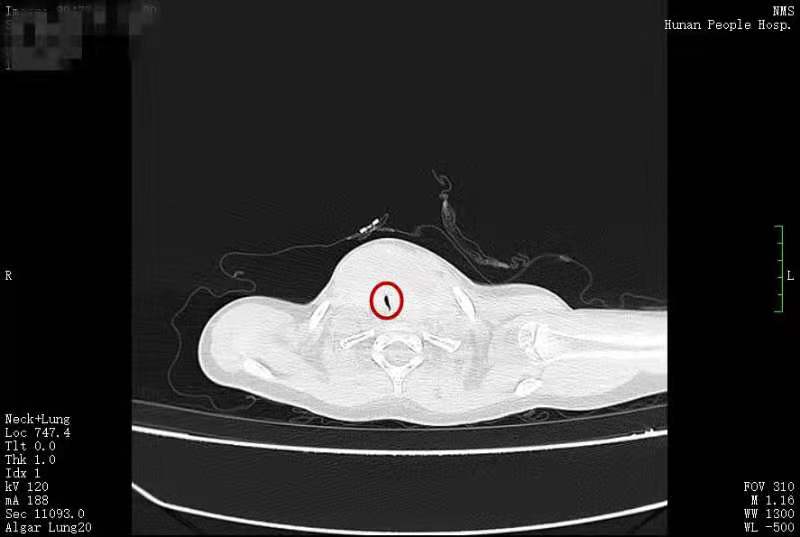 患儿气管被压迫后最细的地方只有3毫米。