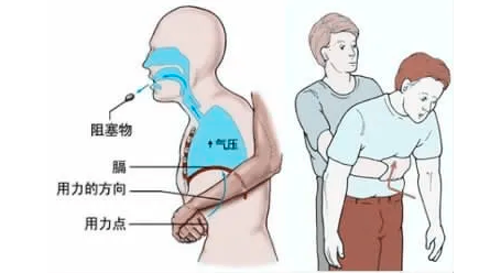 海姆立克急救法