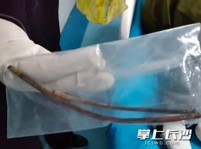 仅仅用了5分钟，医生就运用异物钳将一根长15厘米、粗约6毫米的铁丝取出来了。长沙晚报通讯员 王天晓 供图