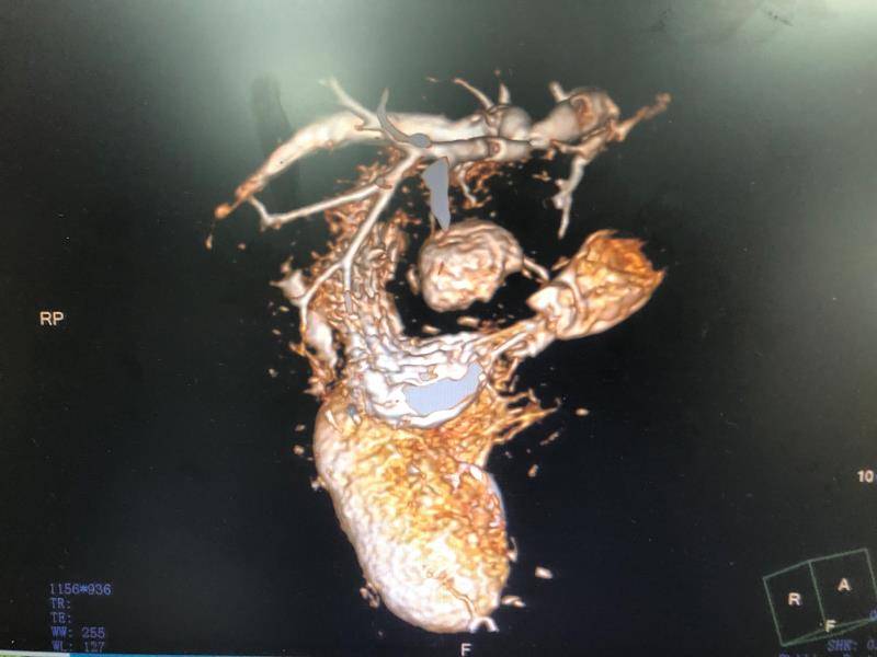 磁共振三维重建可见：脾脏、胃、十二指肠反位。均为长沙晚报通讯员 梁辉 蔡翊 隆艳飞 供图