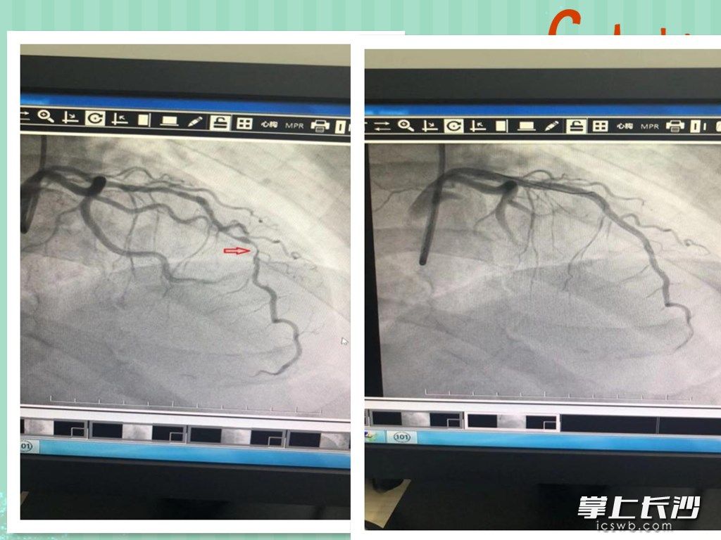 奚先生支架手术术前（左）、术后（右）对比，箭头处为前降支血管约有95%的狭窄。医院 供图