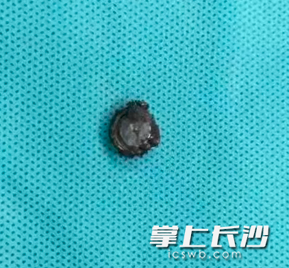 一颗直径不到5毫米的纽扣电池从患儿的鼻腔中顺利取出。