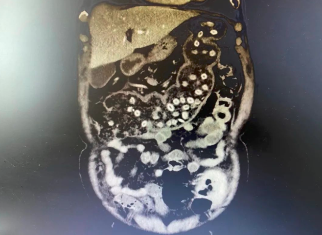 CT检查结果显示:患者肚子里密密麻麻的杨梅核仿佛连成一串“珍珠项链”了。医院供图 CT检查结果显示:患者肚子里密密麻麻的杨梅核仿佛连成一串“珍珠项链”了。医院供图