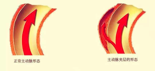 主动脉夹层（AD）是一种严重的心血管急危重症。医院供图