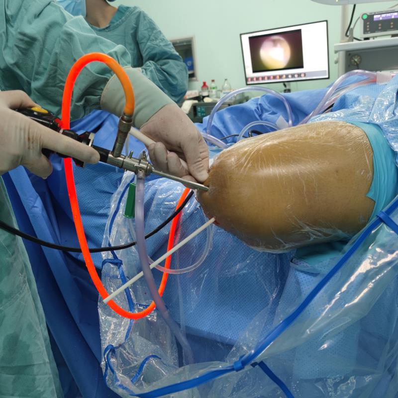 湖南省人民医院骨关节与运动医学专家为患者施行3D技术辅助关节镜下微创前交叉韧带重建术。