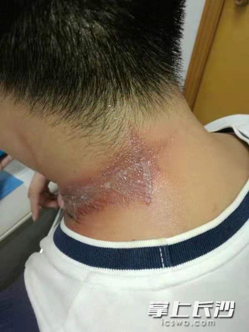 患者后颈部灼热、疼痛，皮肤红了一大片，同样被诊断为隐翅虫皮炎。  医院供图