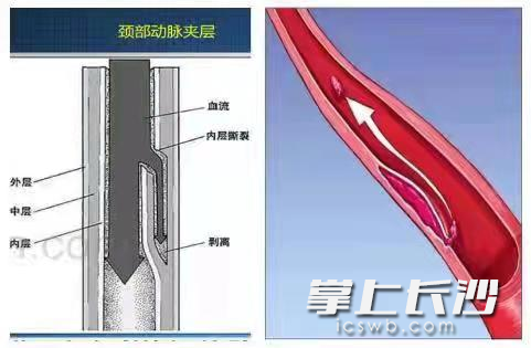颈内动脉夹层