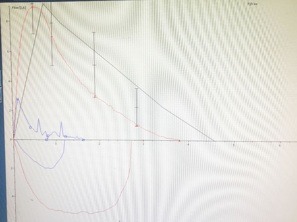 图为患者治疗前后肺功能检查结果对比，蓝色是患者发作时肺功能显示为极重度混合型通气功能障碍，红色为治疗恢复后显示肺功能正常。两者上升变化率为287.6％。