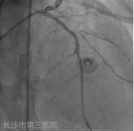 术后冠脉造影