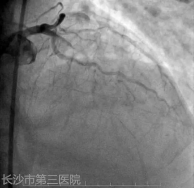 术前冠脉造影。均为医院供图