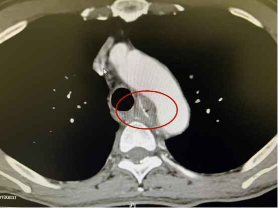 患者鱼刺卡喉胸主动脉CTA检查示意图。由医院供图