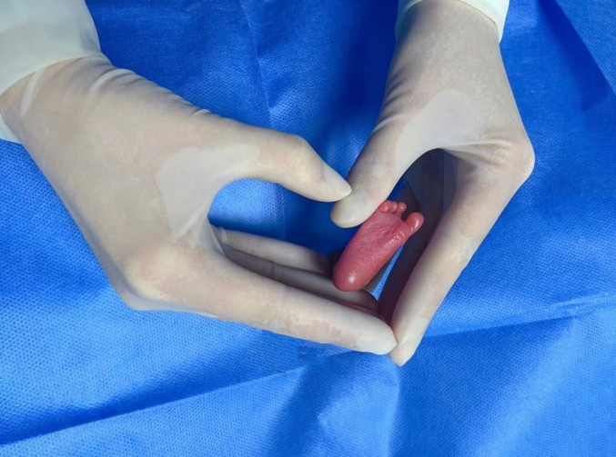 刚出生的童童小脚比成人拇指都短。