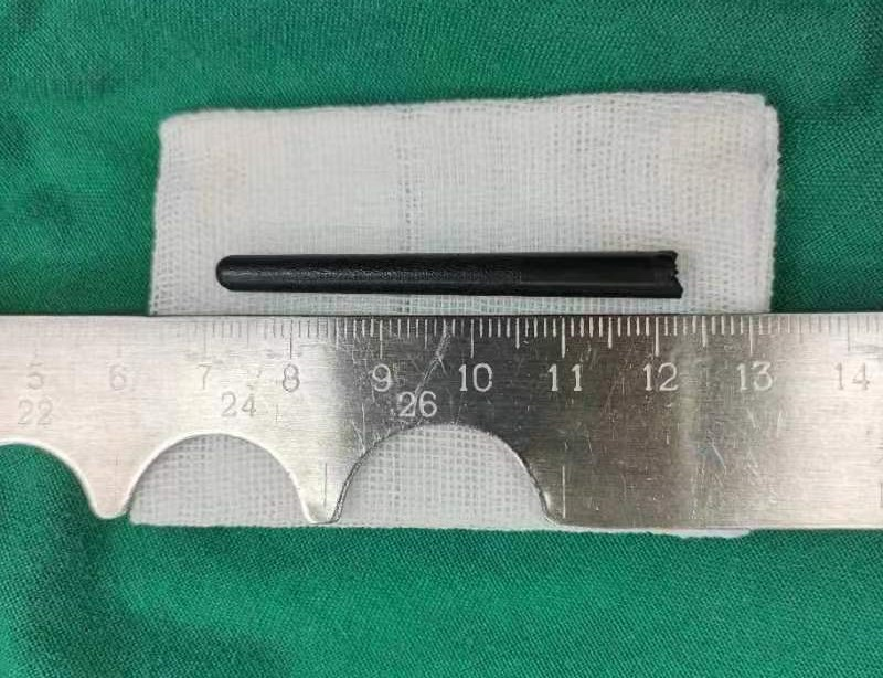 从小疆体内取出的筷子。