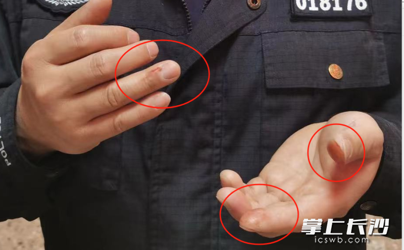 杨桂平的双手，曾多次在出警过程中受伤。长沙晚报通讯员 林鑫 供图