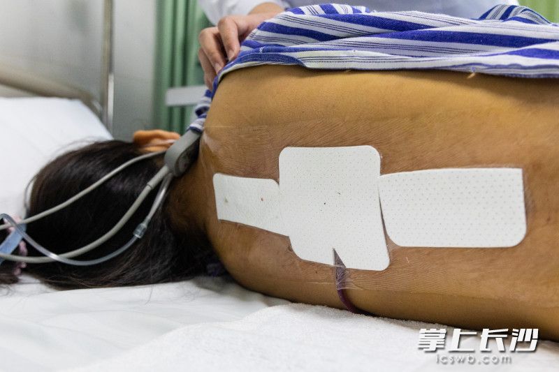 专家提醒,侧弯角度大于40度、胸腰弯/腰弯大于35度者;支具治疗不能控制,侧弯快速进展者;腰背疼痛明显或有神经压迫症状者,需尽快进行手术治疗。长沙晚报全媒体记者 董阳 摄 专家提醒,侧弯角度大于40度、胸腰弯/腰弯大于35度者;支具治疗不能控制,侧弯快速进展者;腰背疼痛明显或有神经压迫症状者,需尽快进行手术治疗。长沙晚报全媒体记者 董阳 摄