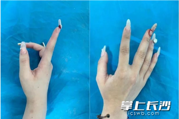 小李的延长甲片被掀翻。 小李的延长甲片被掀翻。