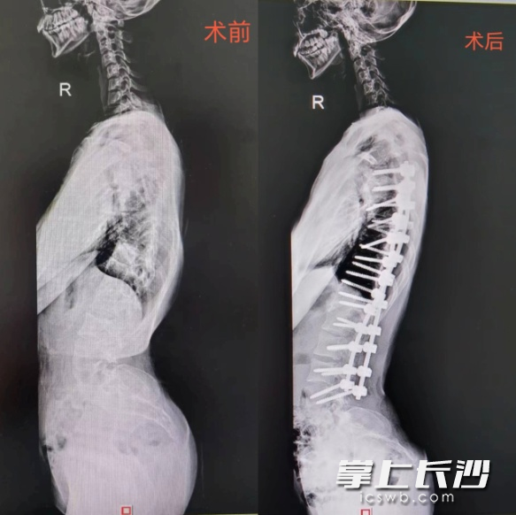 小琳术前术后X线检查对比图。 小琳术前术后X线检查对比图。