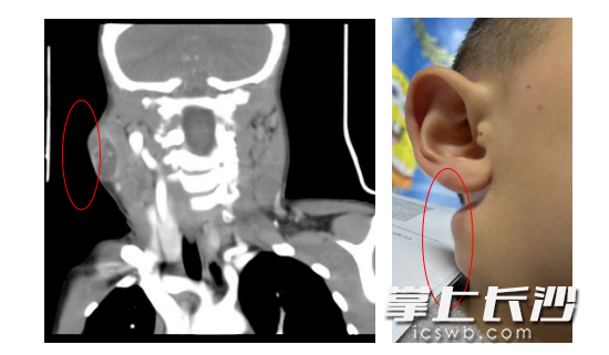 患儿颈部CT检查提示,颈部有多发淋巴结肿大。医院供图 患儿颈部CT检查提示,颈部有多发淋巴结肿大。医院供图