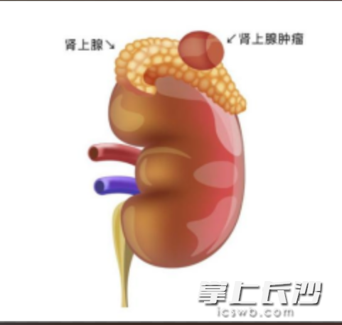 肾上腺肿瘤示意图。